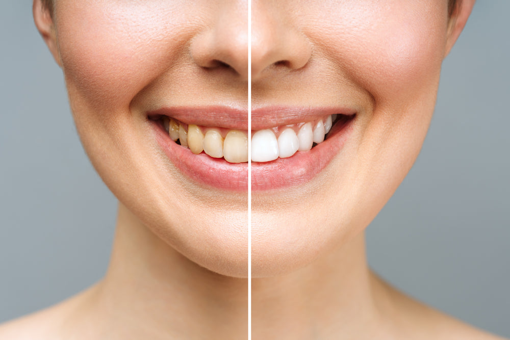 Before and after photograph of a woman, with her teeth yellow (before) on the left and white (after) on the right.