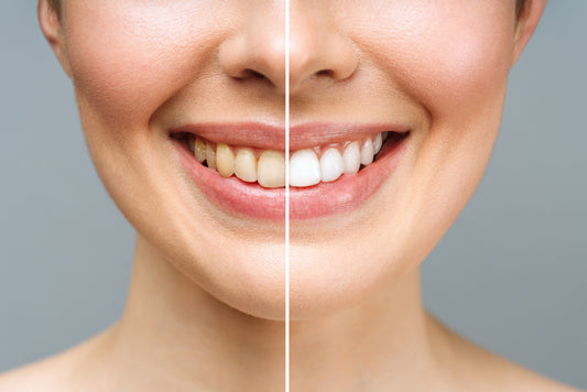 Before and after photograph of a woman, with her teeth yellow (before) on the left and white (after) on the right.