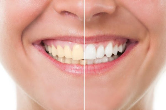 Are Yellow Teeth Bad?